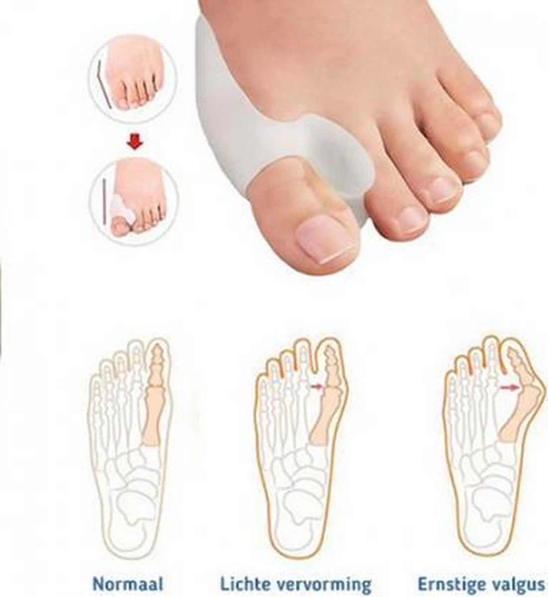 MYCARE+ Teencorrector - Wasbare Teencorrector - Gel-laag - 1 Paar - Pijn Verlichtend - Afbeelding 6