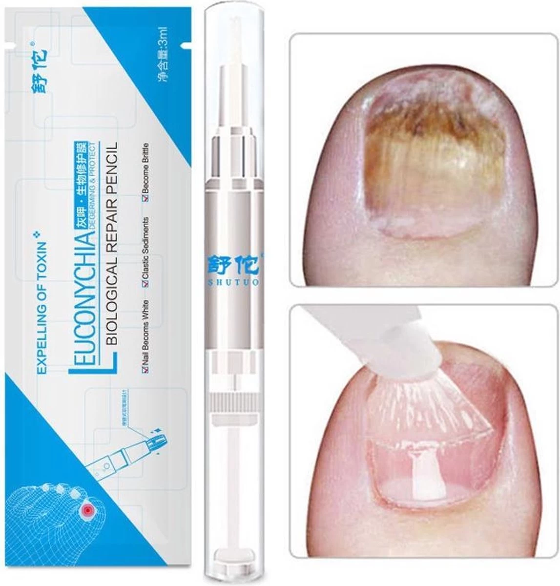 Anti- Kalknagel Behandeling Puur Natuur