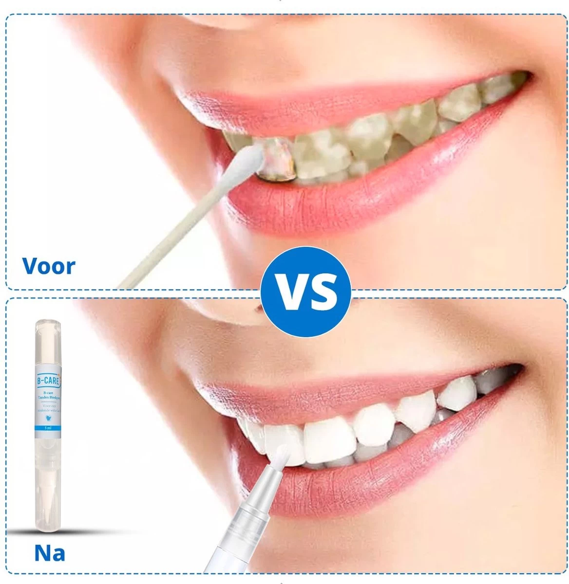 B-care Tanden Bleekpen - Teeth Whitening Pen - Tanden Bleker - Wittere Tanden - Teeth Whitening Strips - Professioneel Resultaat - Tandsteen Verwijderaar - Zonder Peroxide - Tandenbleekset - Tanden Bleken - Afbeelding 2