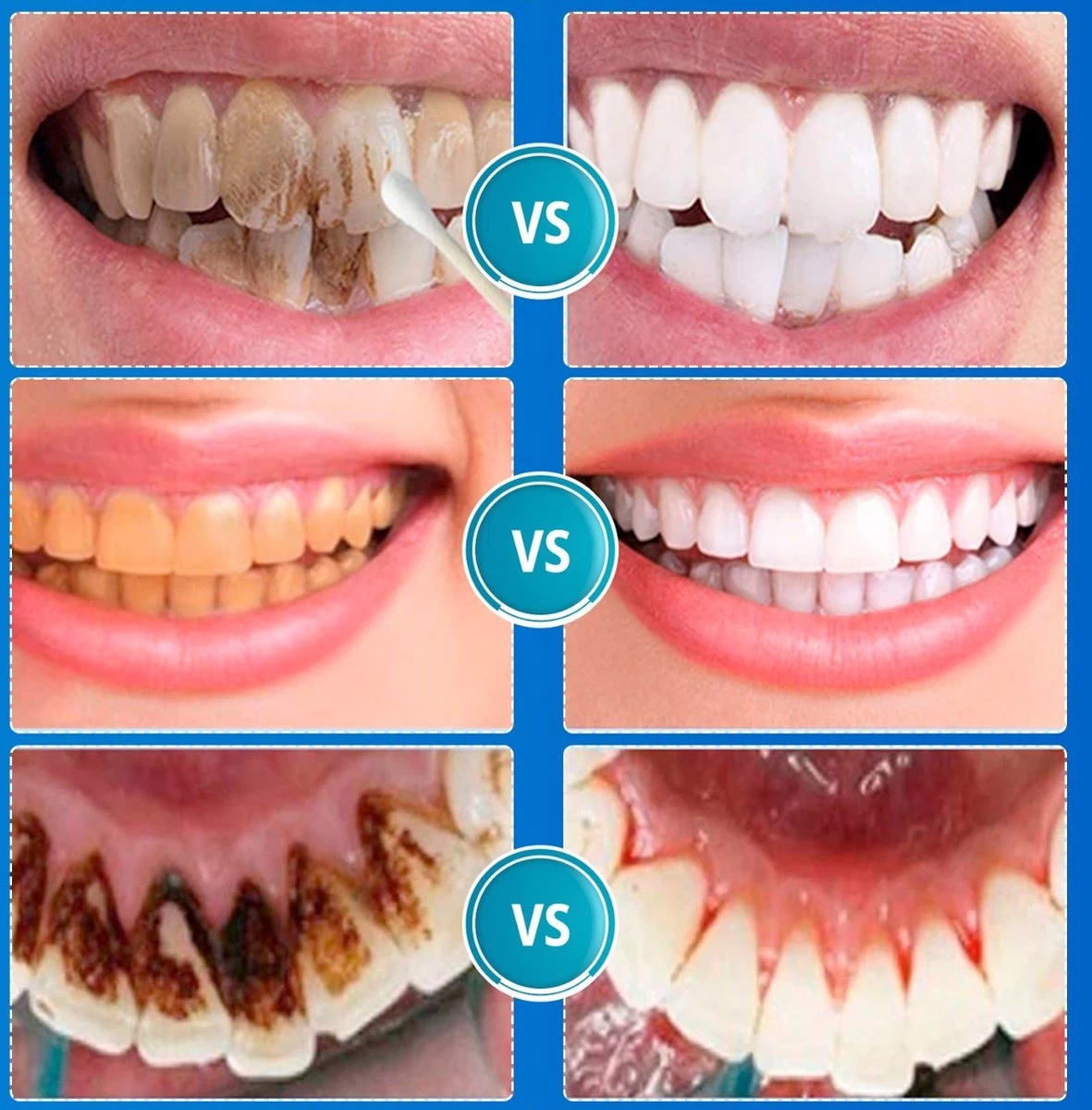 B-care Tanden Bleker – Wittere Tanden – Teeth Whitening Strips – Professioneel Resultaat - Tandsteen Verwijderaar - Zonder Peroxide - Tandenbleekset - Tanden Bleken - Afbeelding 11