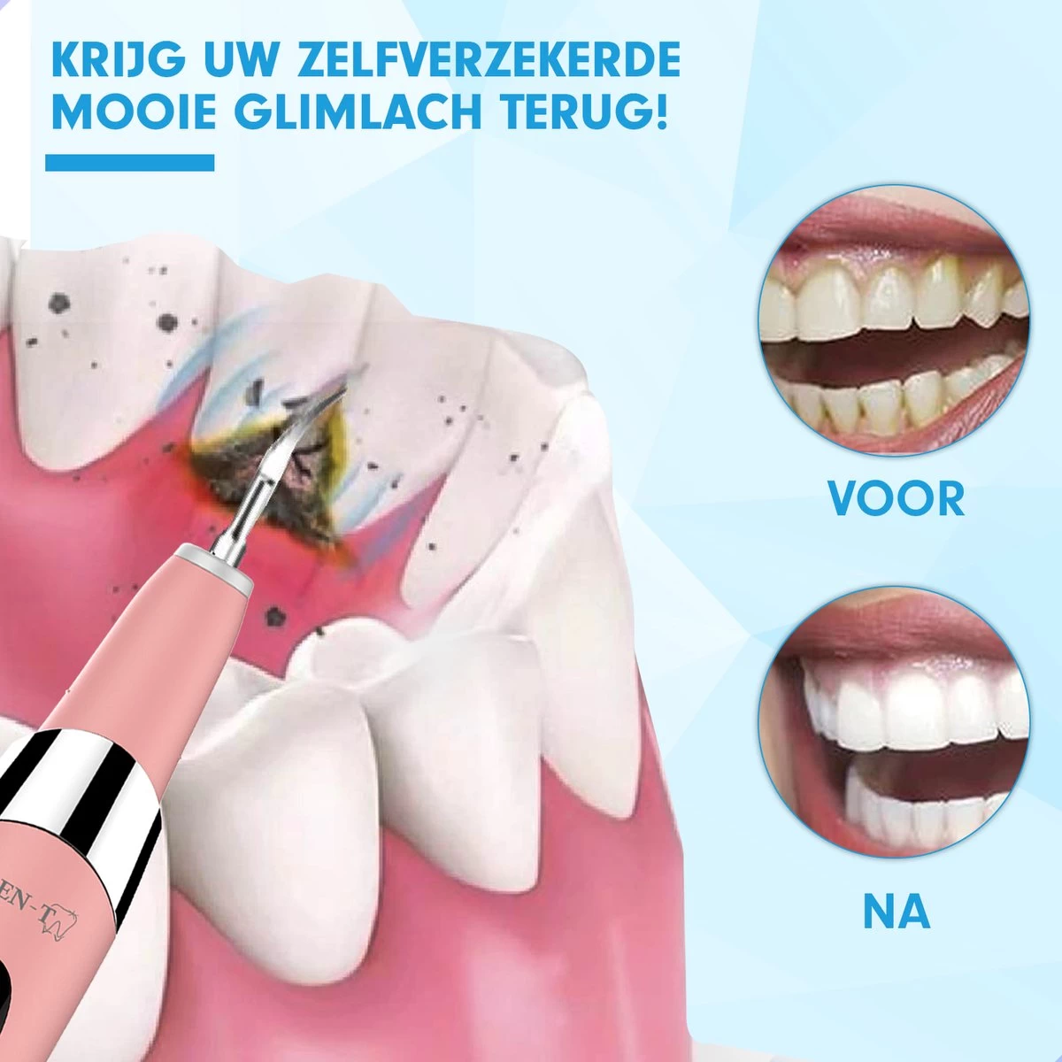 DEN-T® PRO U500 - Elektrische Sonische Tandsteen Verwijderaar - Roze - Afbeelding 8