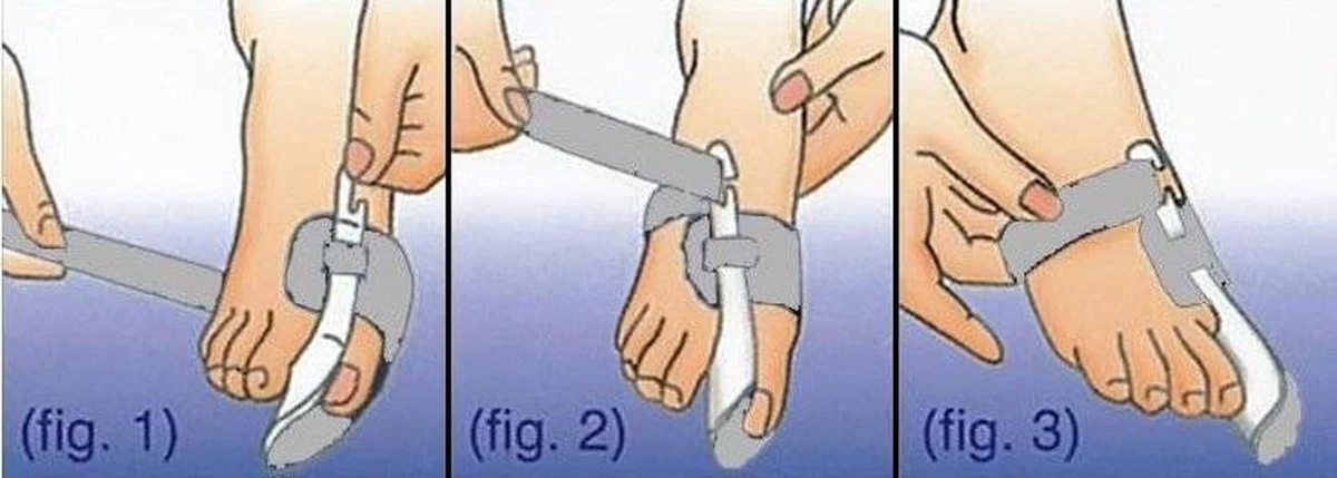 Hallux Valgus Statische Nachtspalk - Rechts + Links - Foot Pijnbestrijding - Teen Separator - Duim Corrector - Blauw / Wit - Afbeelding 5