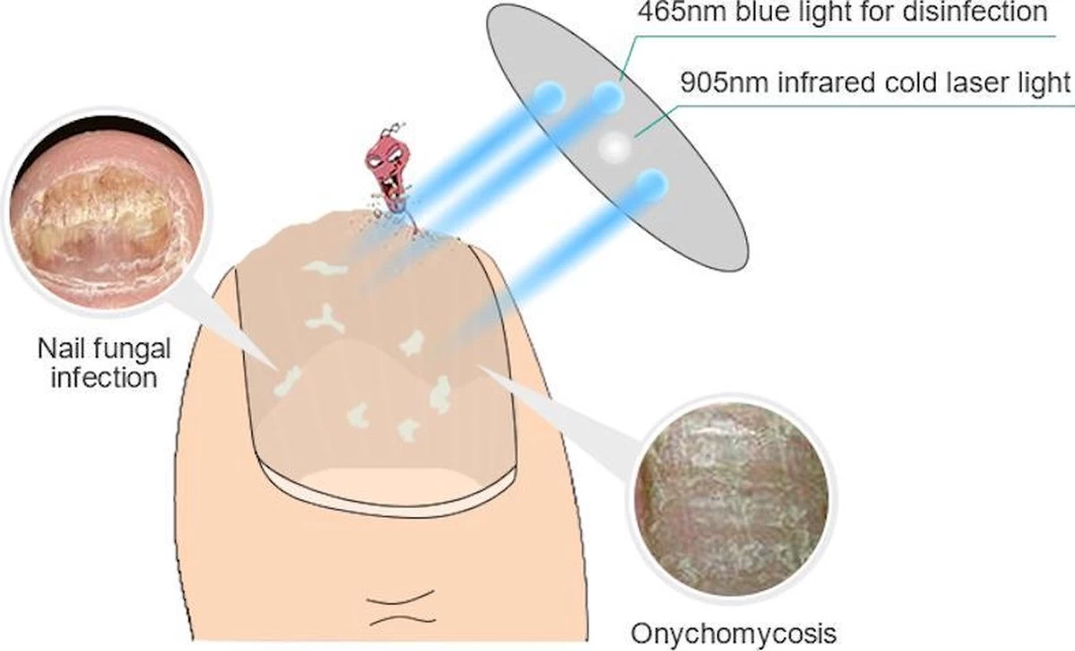 Anti Schimmelnagel Kalknagel Laserapparaat Om Zelf Te Behandelen, Veilig, Effectief, Snel En Pijnloos, Koude Laser Behandeling Voor Thuisgebruik, Voor Tenen En Vingers. Oplaadbaar. - Afbeelding 2