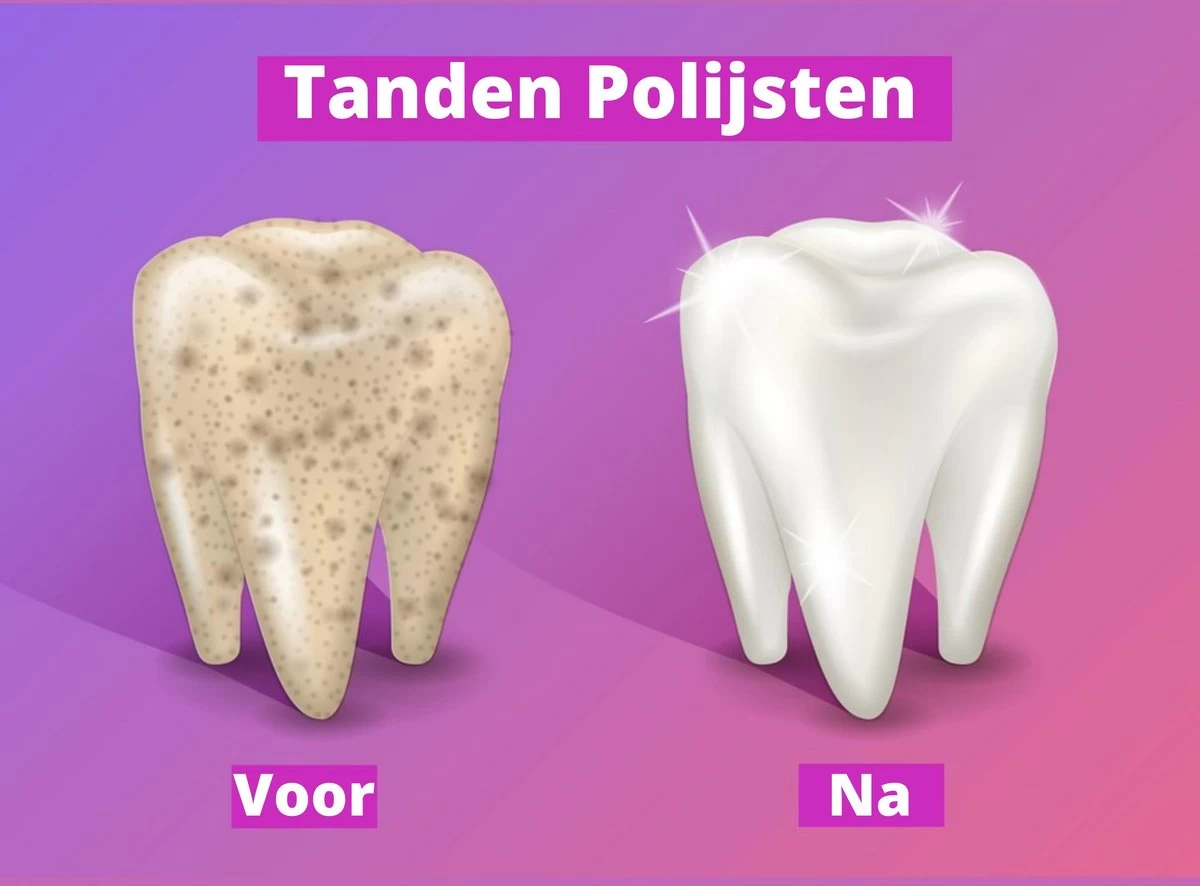 Merkloos HQ Tooth Polisher - Tanden Polijsten - Wittere Tanden - Tandsteen Tandplak Verwijderaar - Elektrisch - Afbeelding 5