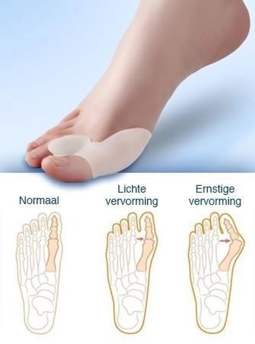 MYCARE+ Teencorrector - Wasbare Teencorrector - Gel-laag - 1 Paar - Pijn Verlichtend - Afbeelding 4